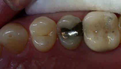 Amalgam removal before