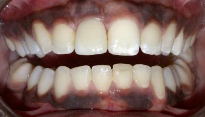 Replace front tooth with bone level implant After