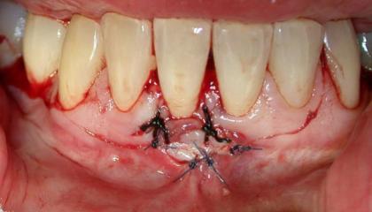 Gum transplant during