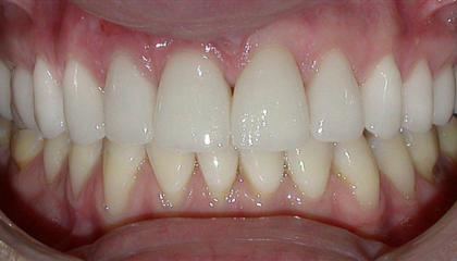 e Max ceramic crowns and veneers after