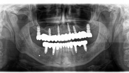 Panoramic x ray photo after