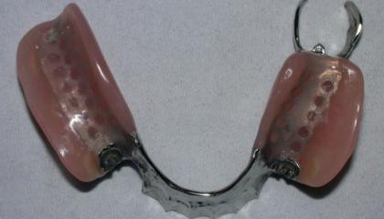 Metal framed partial denture