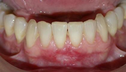 Gum transplant after