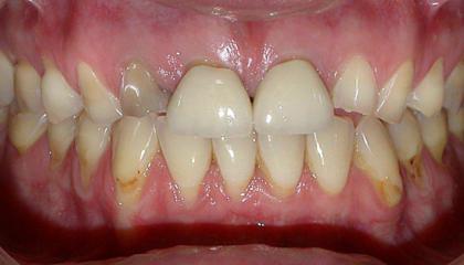 e Max ceramic crowns and veneers before