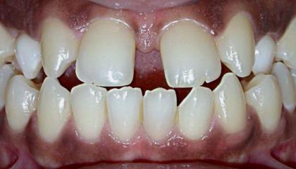 Closure of the gap and changing the canine teeth to laterals