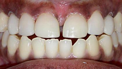 Closure of the gap and changing the canine teeth to laterals after