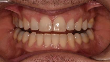 After   Clear aligners