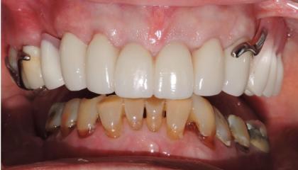 Crown lengthenings, zirconia crowns and metal based partial denture