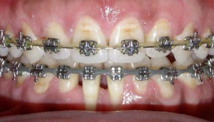 Adult braces during