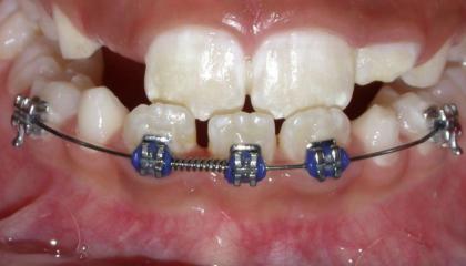 Interceptive braces before