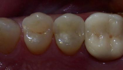 Amalgam removal after