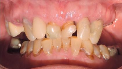 Severely damaged teeth