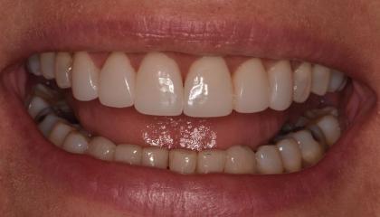 After   Direct resin veneers placed